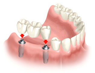 Dental Implants Jaipur 